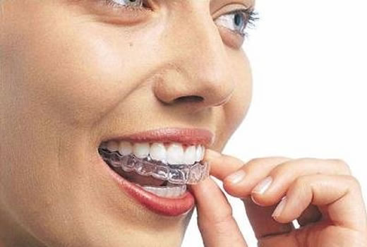 Moldeira para Clareamento Dental